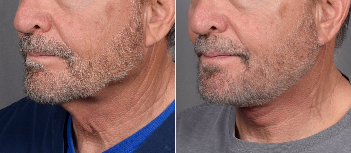 Neck Lift Before & After Gallery - Patient 865548 - Image 7
