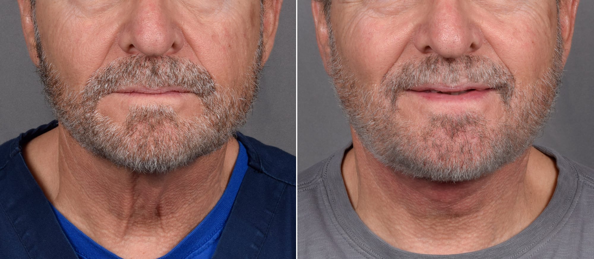 Neck Lift Before & After Gallery - Patient 865548 - Image 6