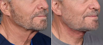 Neck Lift Before & After Gallery - Patient 865548 - Image 1