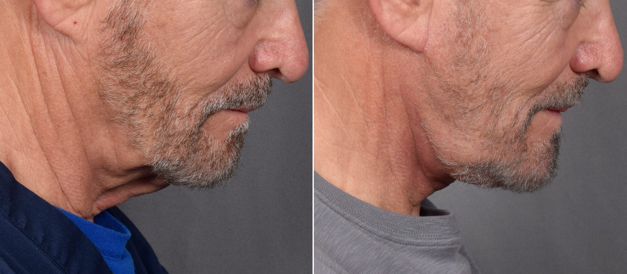 Neck Lift Before & After Gallery - Patient 865548 - Image 3