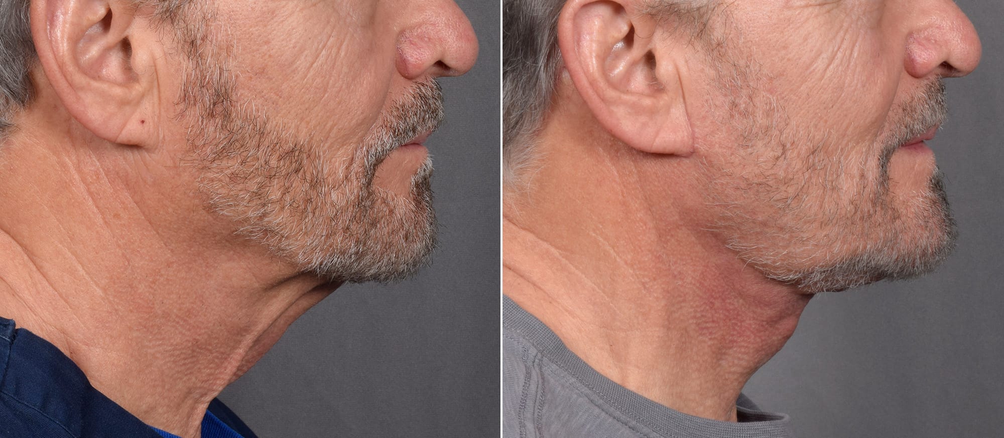 Neck Lift Before & After Gallery - Patient 865548 - Image 2