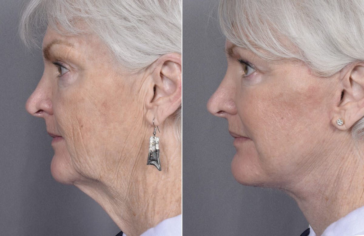 Facelift Before & After Gallery - Patient 284196 - Image 4