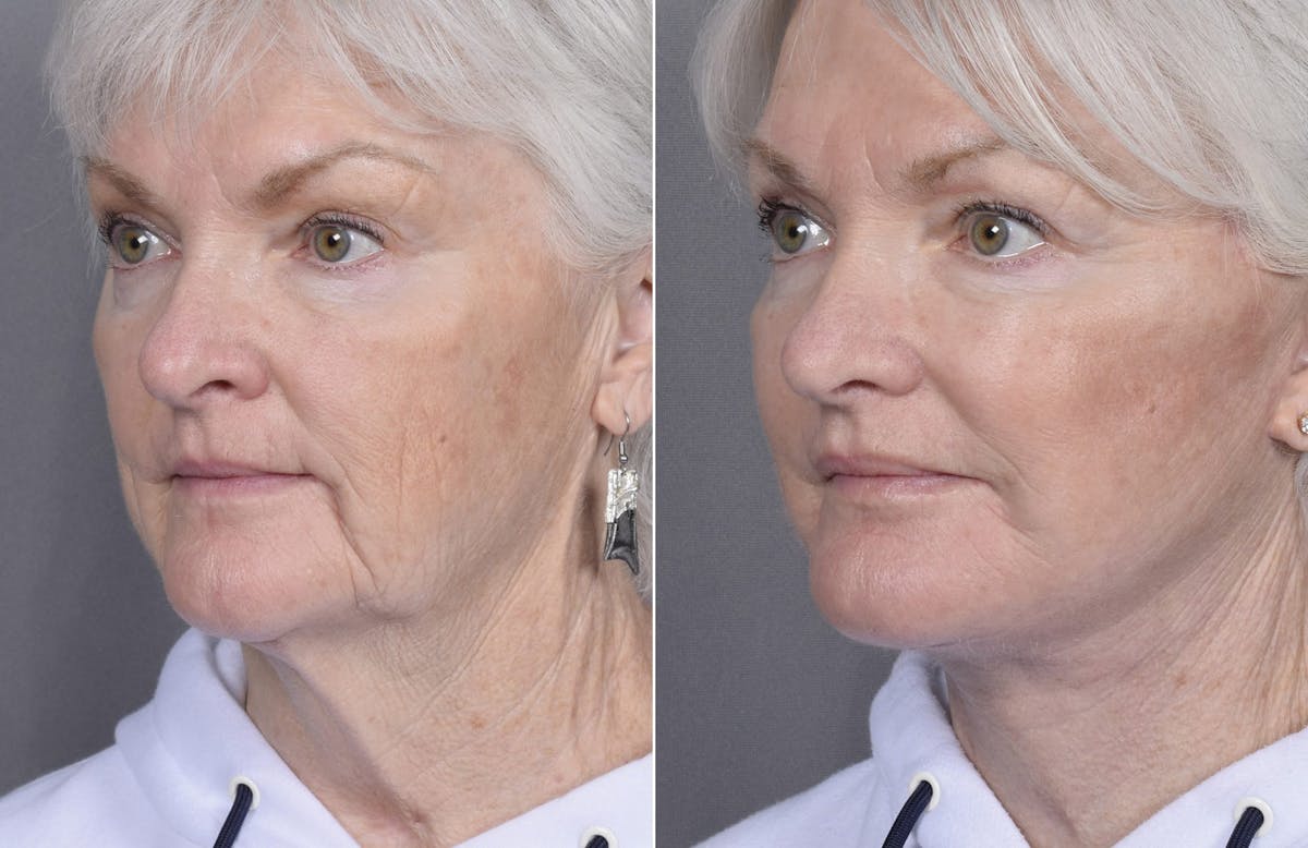 Facelift Before & After Gallery - Patient 284196 - Image 5