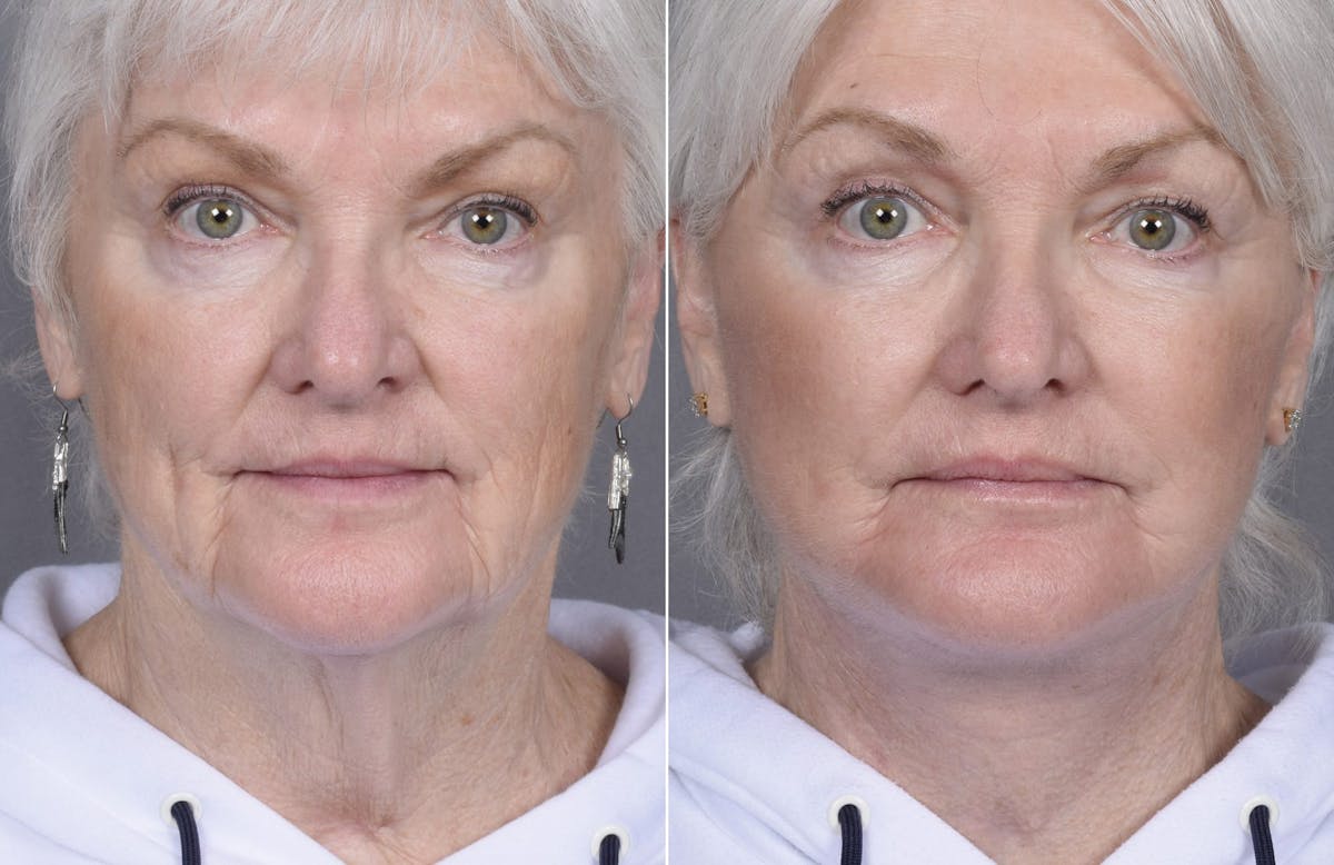 Facelift Before & After Gallery - Patient 284196 - Image 3