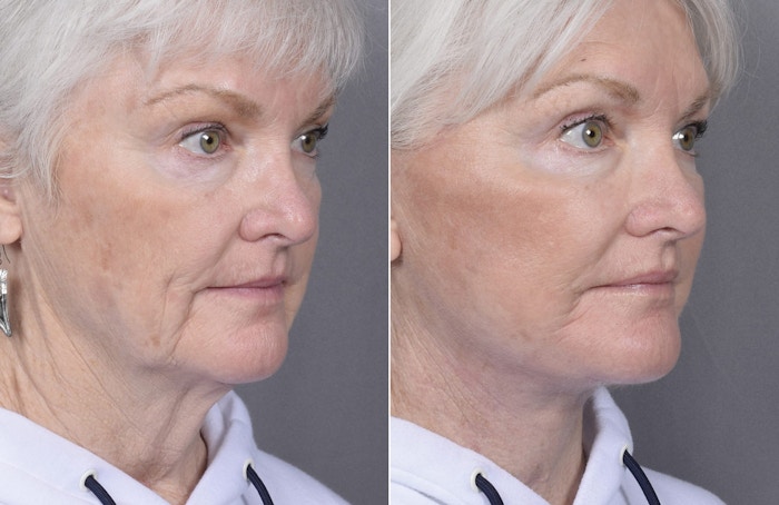 Facelift Before & After Gallery - Patient 284196 - Image 1