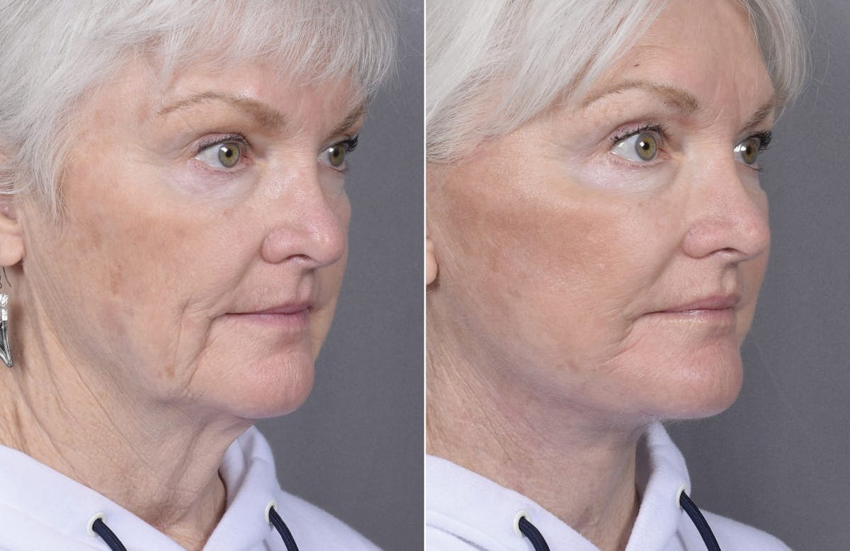Facelift Before & After Gallery - Patient 284196 - Image 1