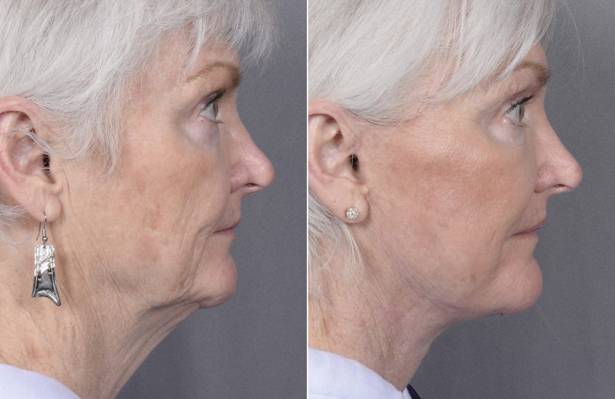 Facelift Before & After Gallery - Patient 284196 - Image 2