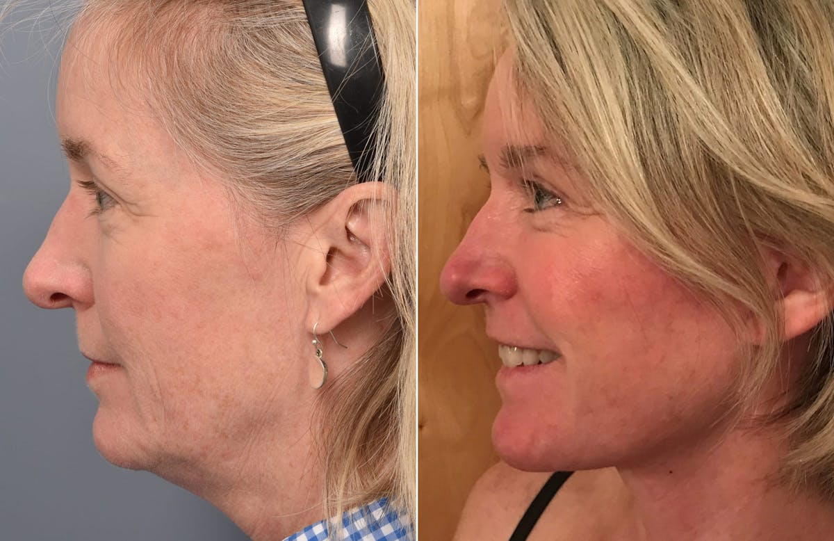 Facelift Before & After Gallery - Patient 287609 - Image 4