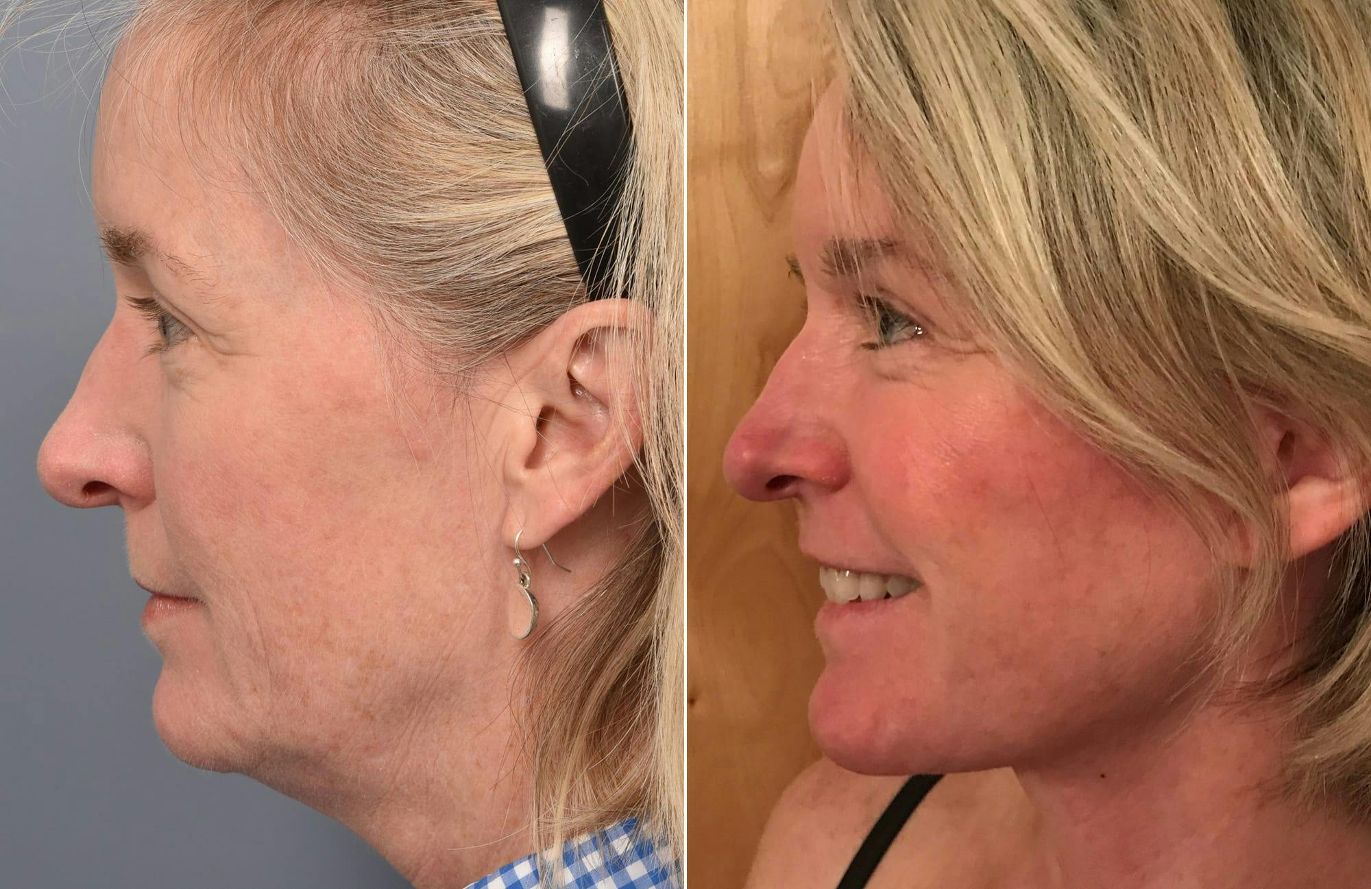 Facelift Before & After Gallery - Patient 287609 - Image 4