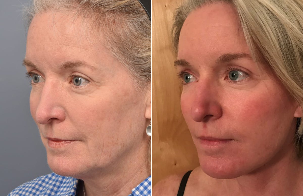 Facelift Before & After Gallery - Patient 287609 - Image 5