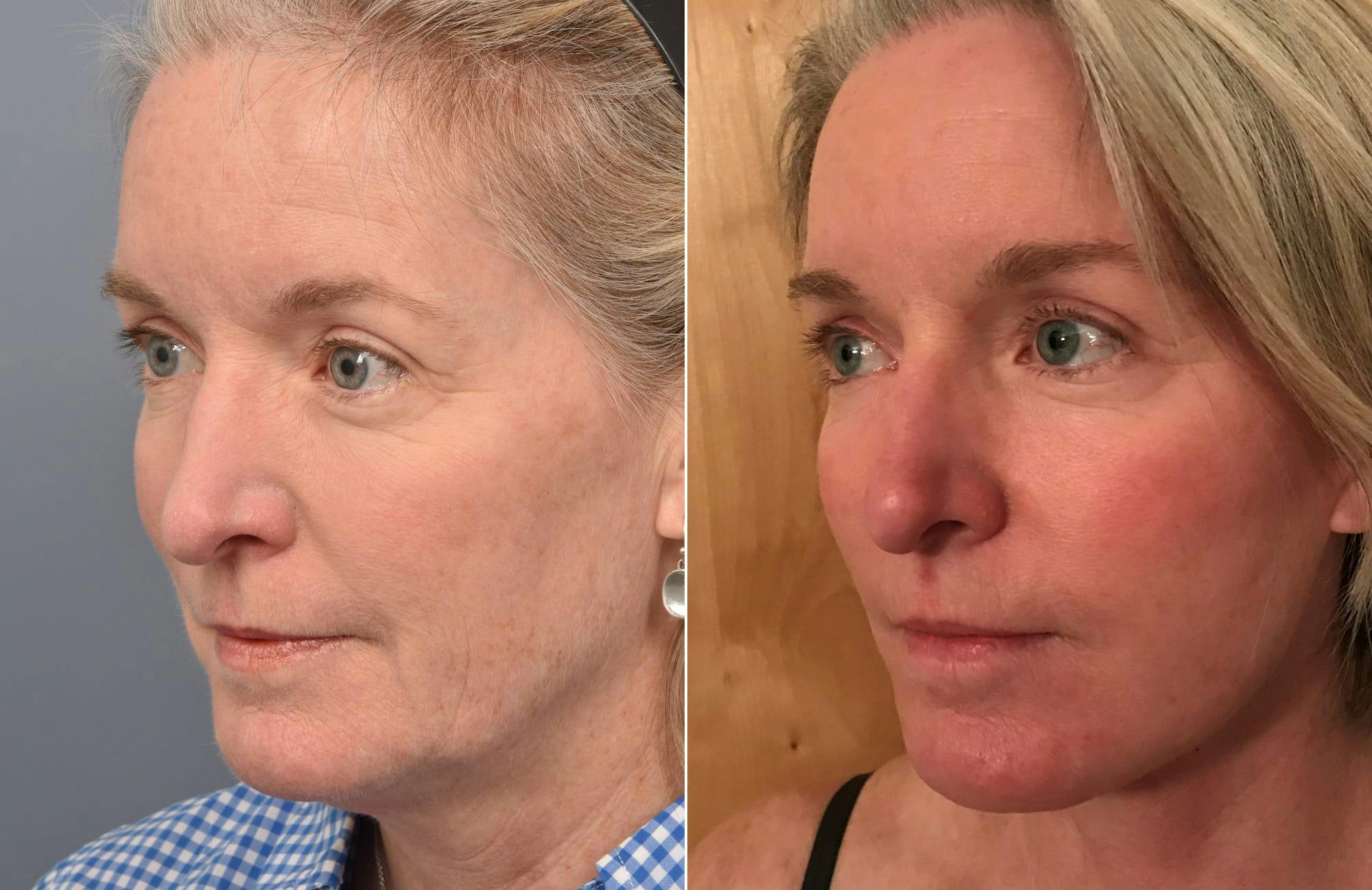 Facelift Before & After Gallery - Patient 287609 - Image 5