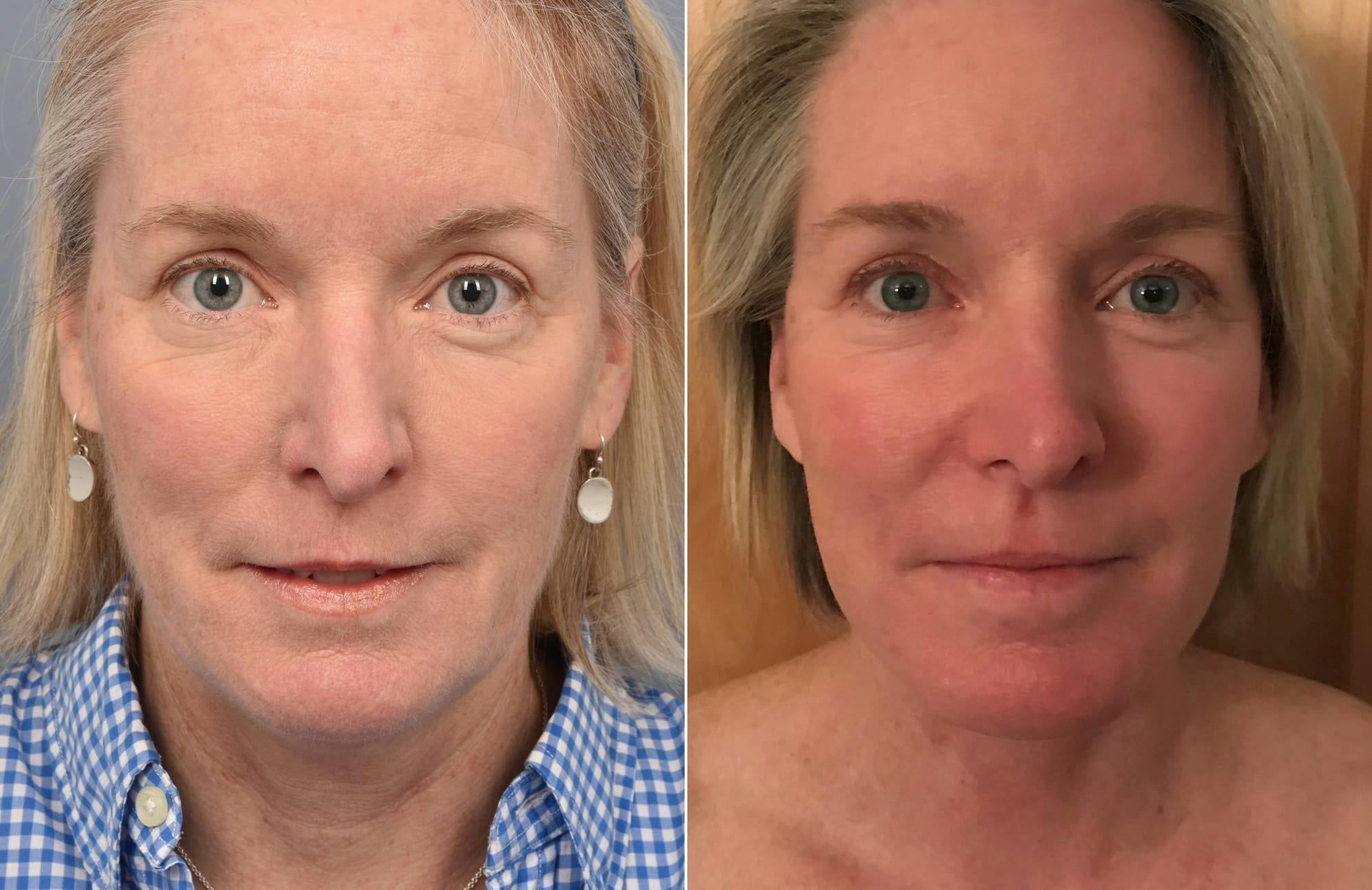 Facelift Before & After Gallery - Patient 287609 - Image 2