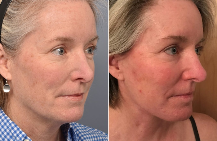Facelift Before & After Gallery - Patient 287609 - Image 1