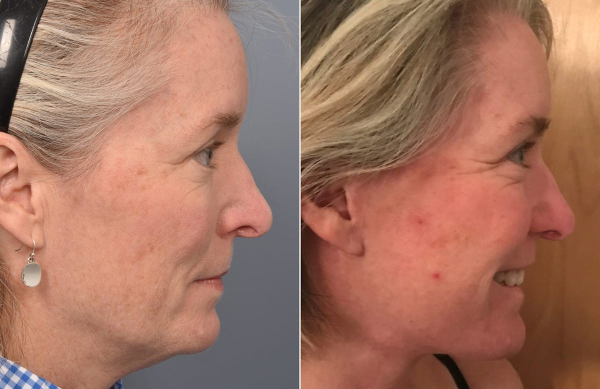 Facelift Before & After Gallery - Patient 287609 - Image 3