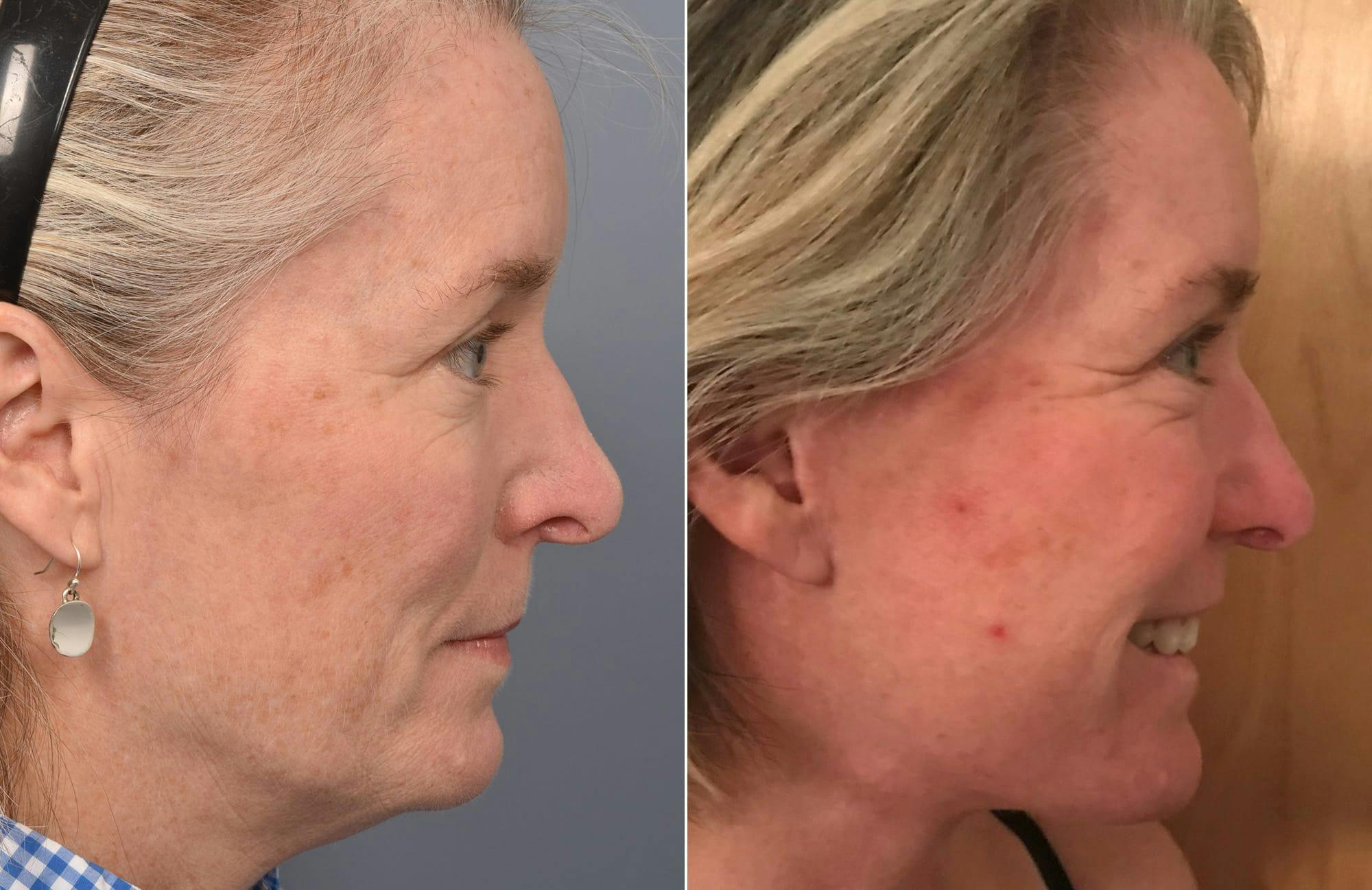 Facelift Before & After Gallery - Patient 287609 - Image 3