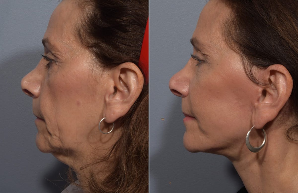 Facelift Before & After Gallery - Patient 242944 - Image 5