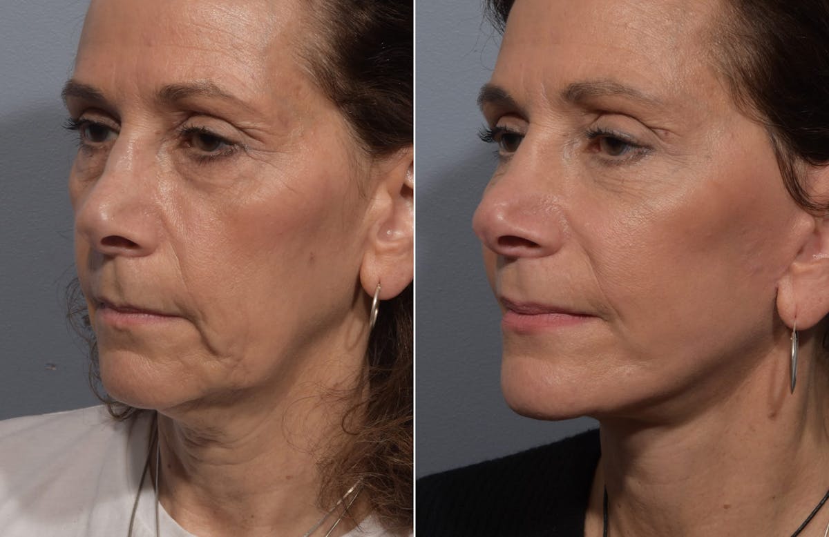 Facelift Before & After Gallery - Patient 242944 - Image 2