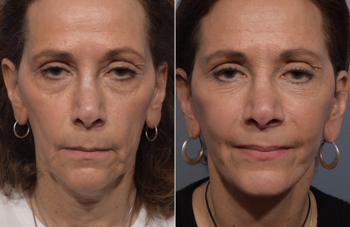 Facelift Before & After Gallery - Patient 242944 - Image 3