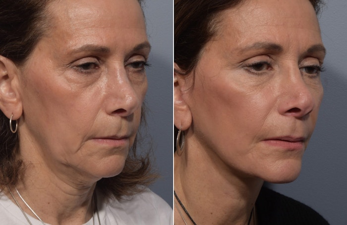 Facelift Before & After Gallery - Patient 242944 - Image 1