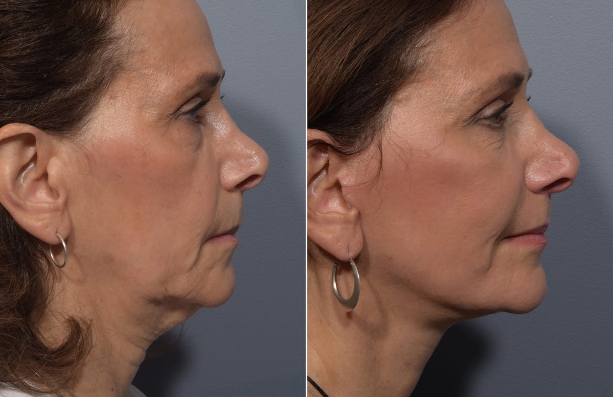 Facelift Before & After Gallery - Patient 242944 - Image 4