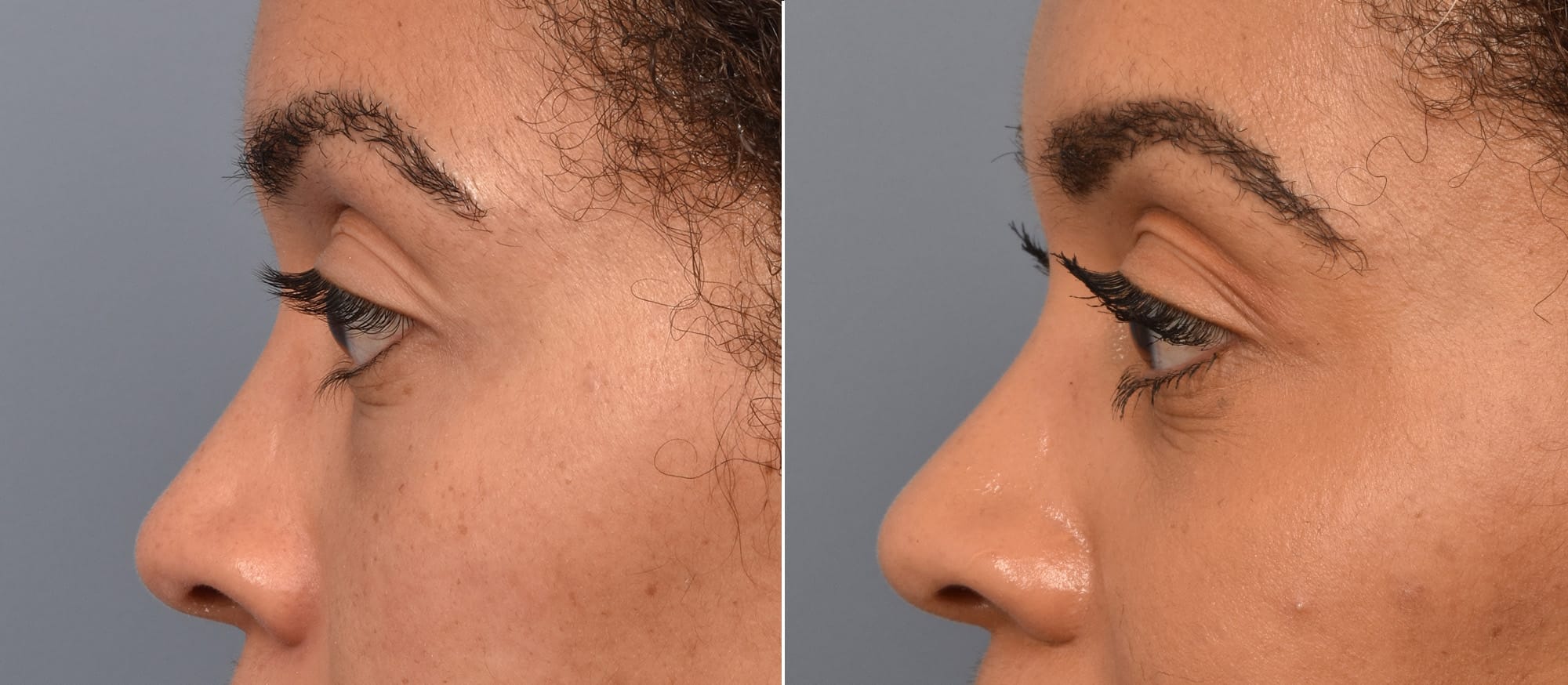 Lower Blepharoplasty Before & After Gallery - Patient 417213 - Image 5