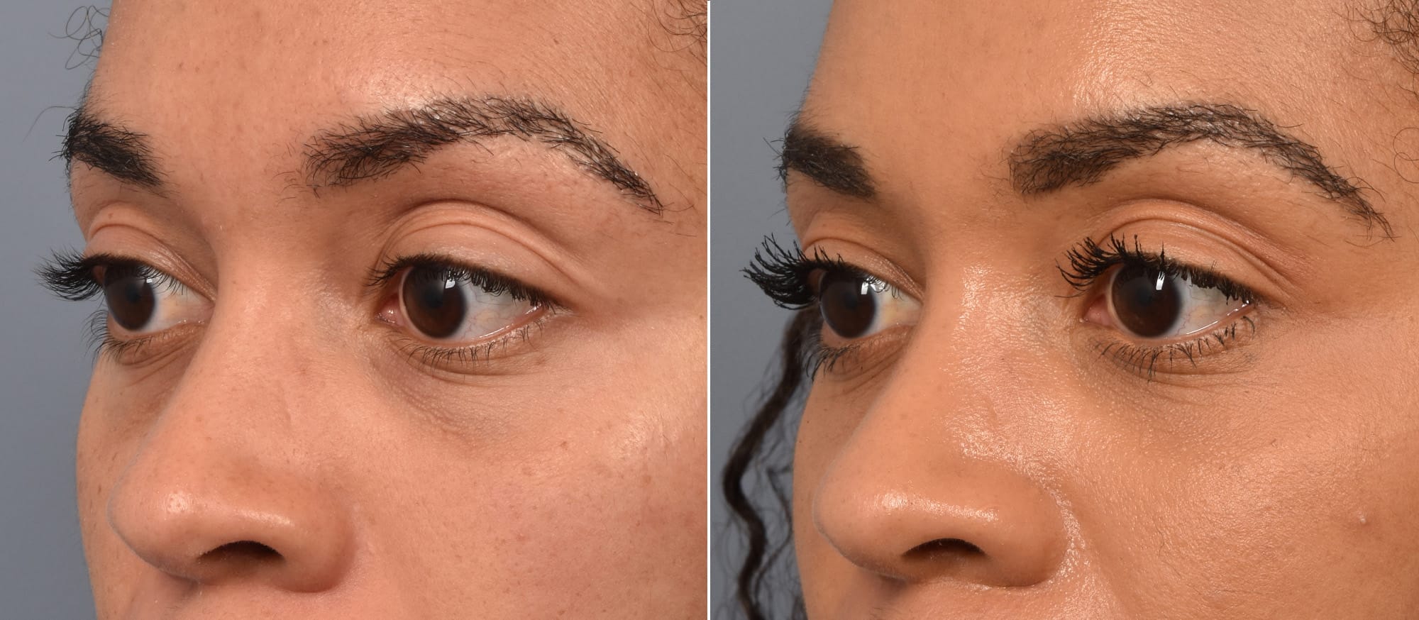 Lower Blepharoplasty Before & After Gallery - Patient 417213 - Image 1