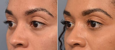 Lower Blepharoplasty Before & After Gallery - Patient 417213 - Image 1