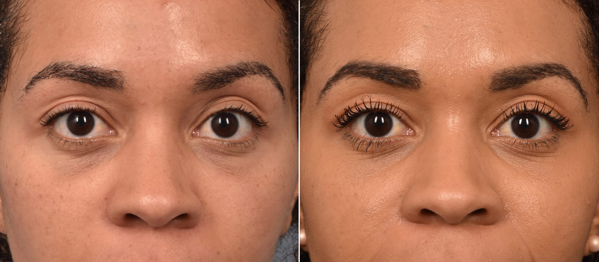 Lower Blepharoplasty Before & After Gallery - Patient 417213 - Image 2