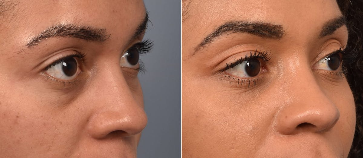Lower Blepharoplasty Before & After Gallery - Patient 417213 - Image 4