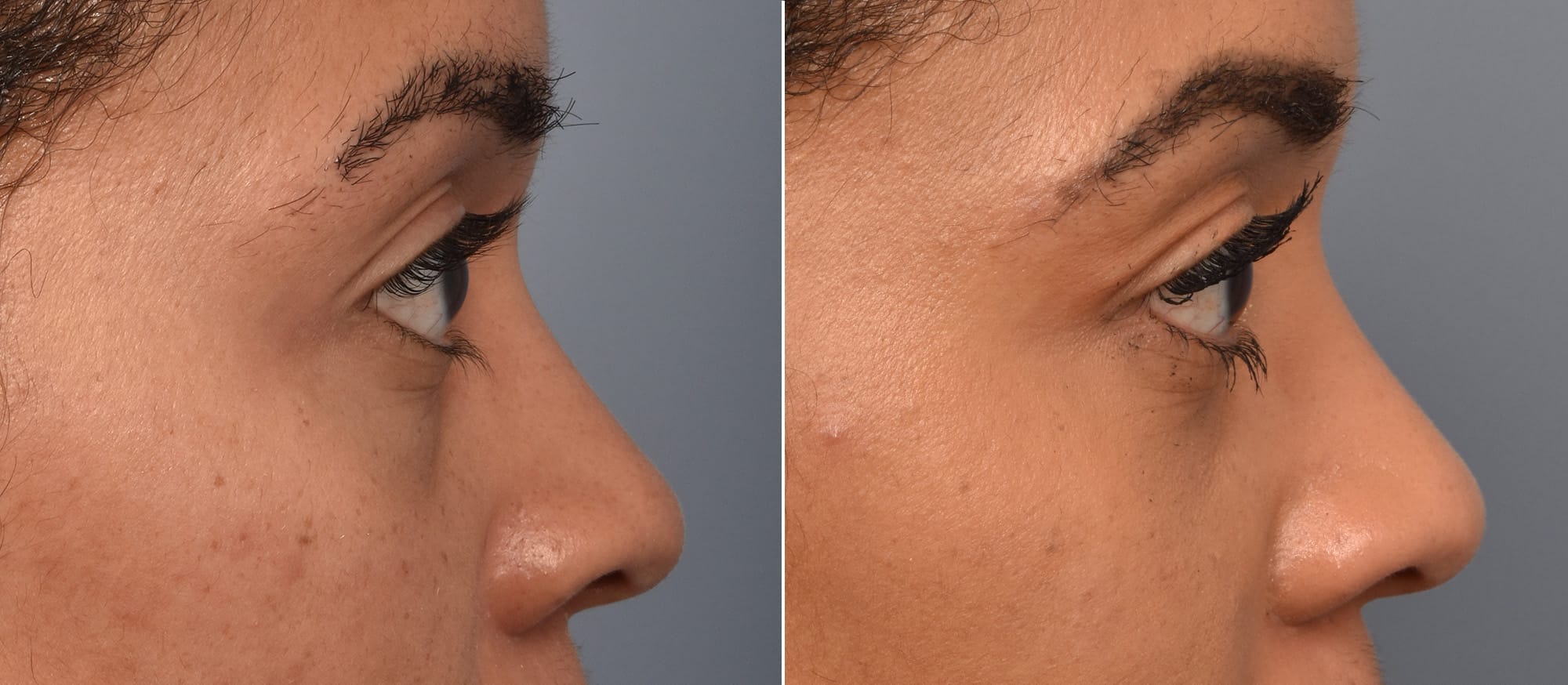 Lower Blepharoplasty Before & After Gallery - Patient 417213 - Image 3