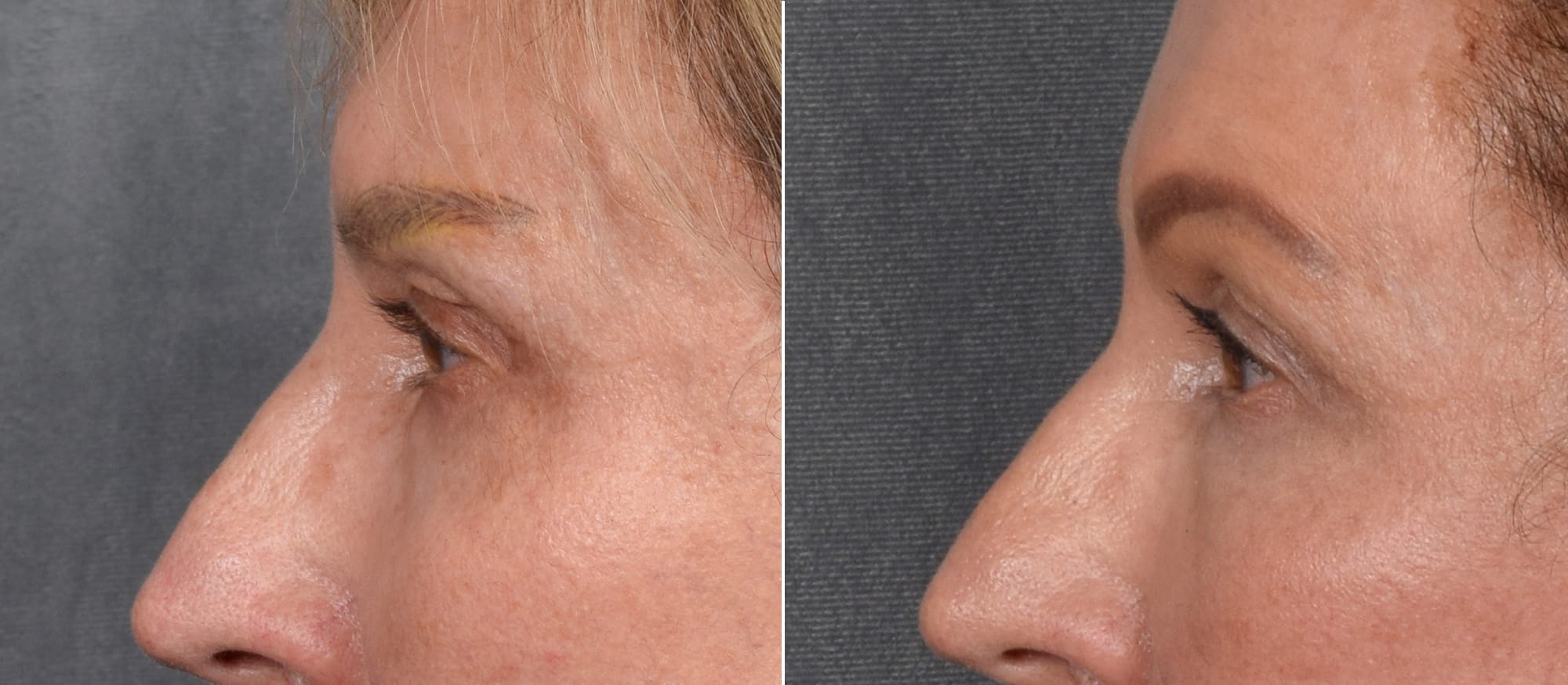 Lower Blepharoplasty Before & After Gallery - Patient 297846 - Image 5