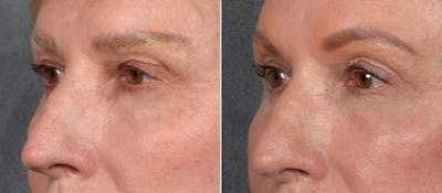 Lower Blepharoplasty Before & After Gallery - Patient 297846 - Image 1