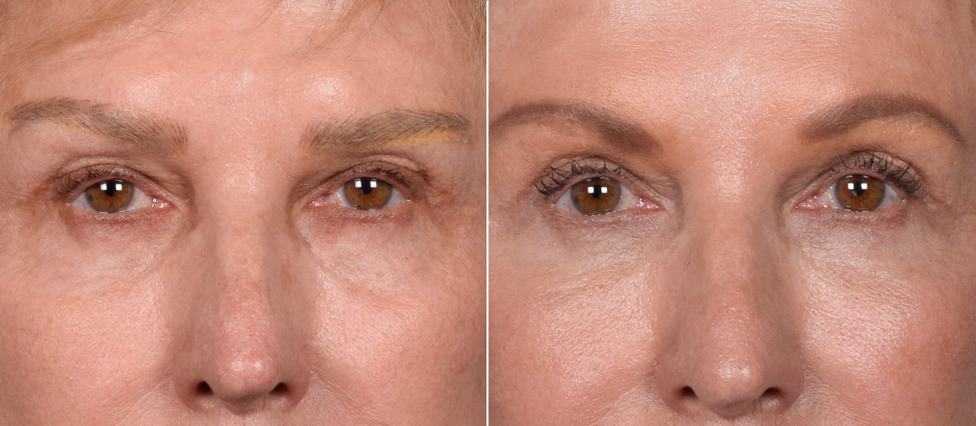 Lower Blepharoplasty Before & After Gallery - Patient 297846 - Image 2