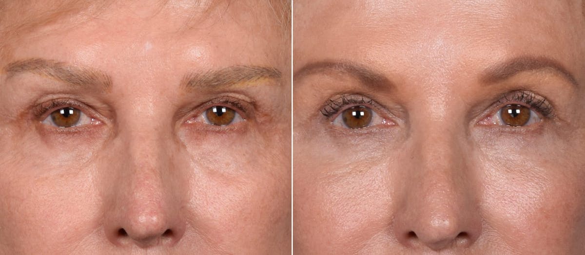 Lower Blepharoplasty Before & After Gallery - Patient 297846 - Image 2
