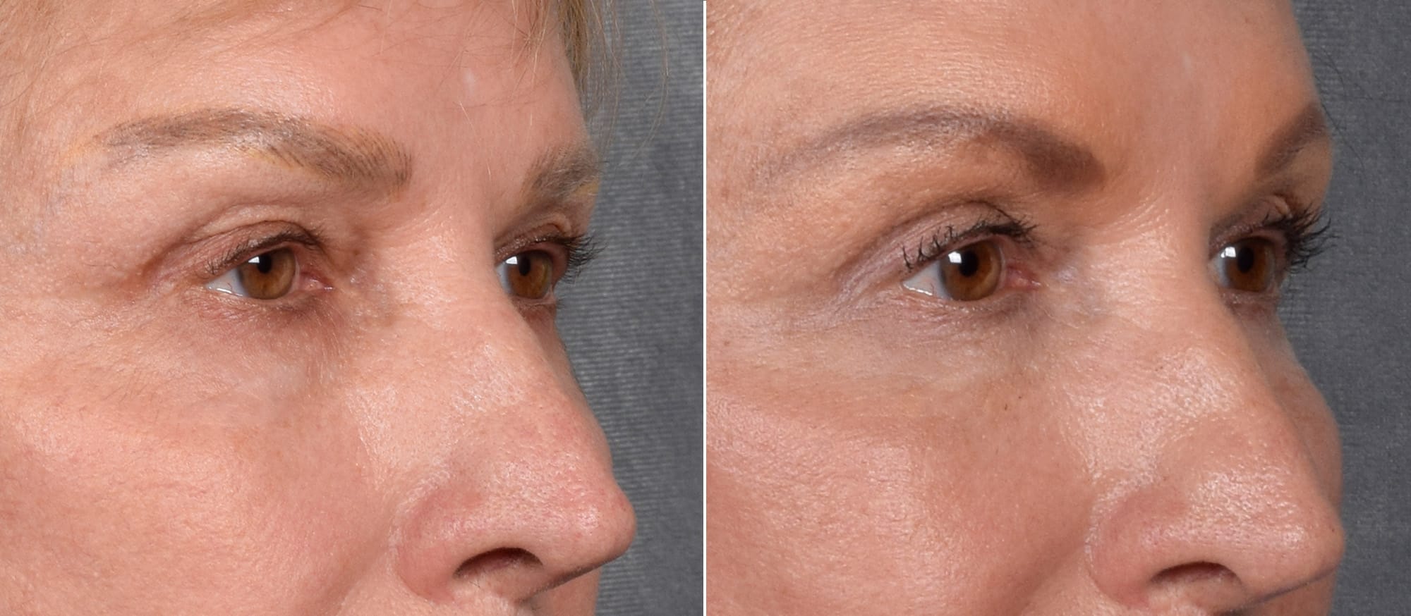 Lower Blepharoplasty Before & After Gallery - Patient 297846 - Image 3