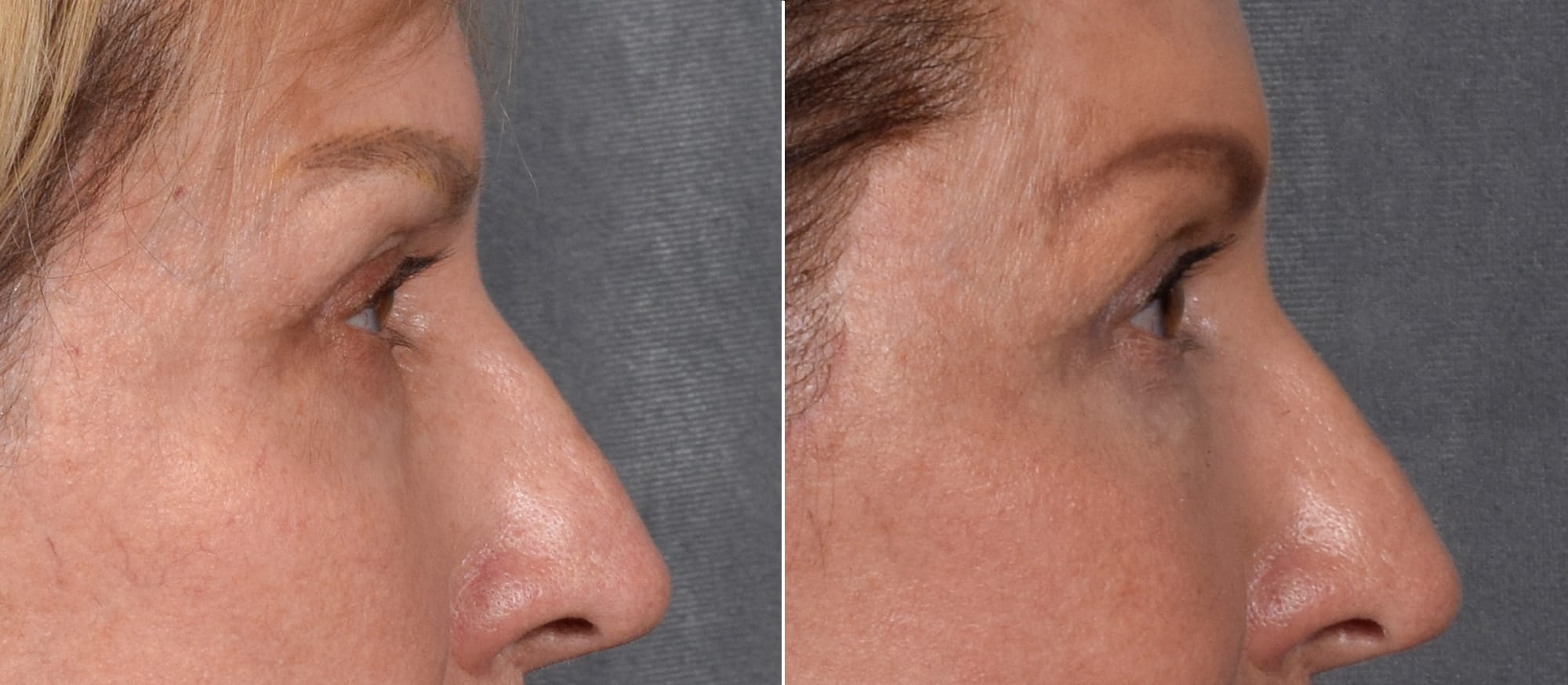 Lower Blepharoplasty Before & After Gallery - Patient 297846 - Image 4