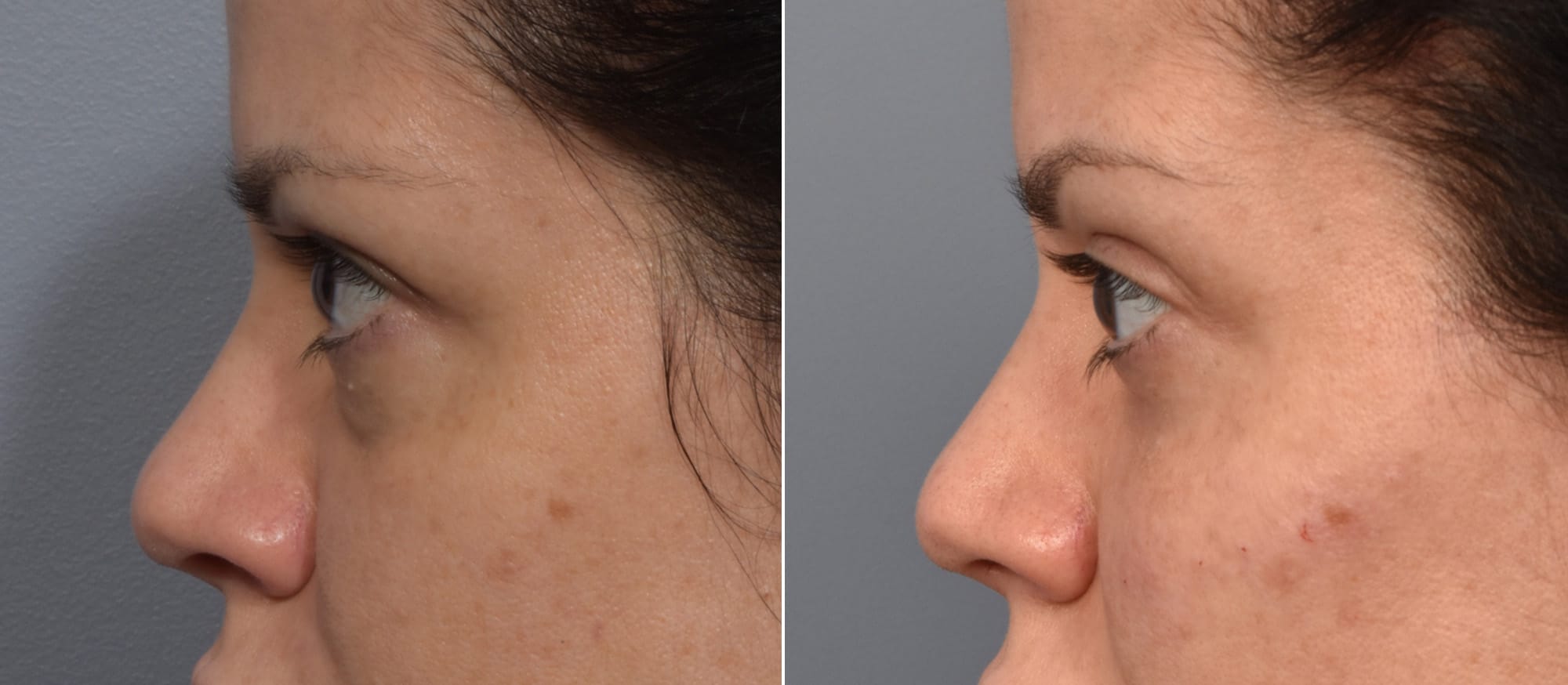 Lower Blepharoplasty Before & After Gallery - Patient 340200 - Image 3