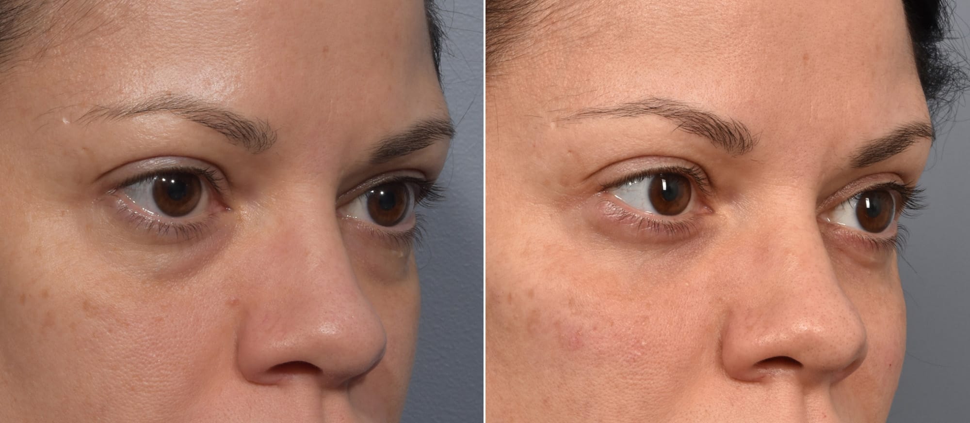 Lower Blepharoplasty Before & After Gallery - Patient 340200 - Image 5