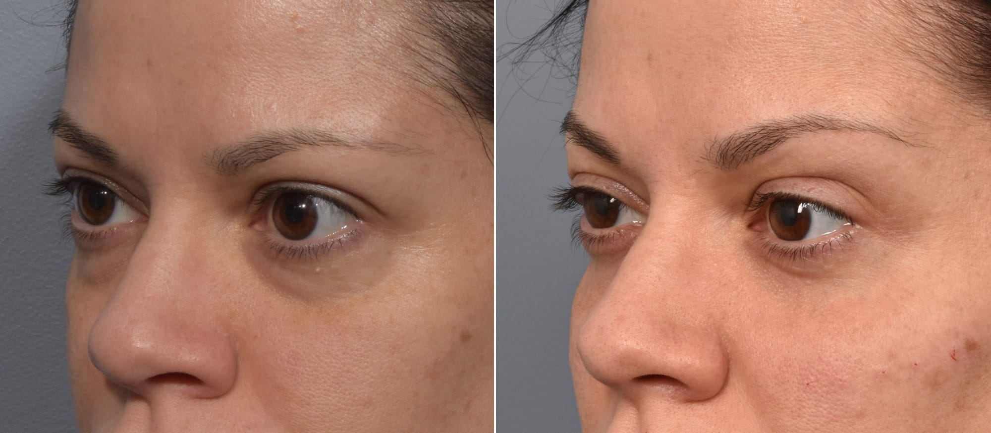 Lower Blepharoplasty Before & After Gallery - Patient 340200 - Image 1