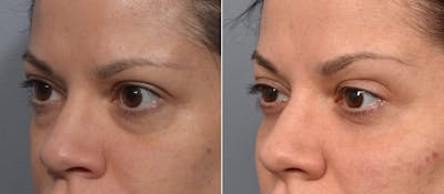 Lower Blepharoplasty Before & After Gallery - Patient 340200 - Image 1