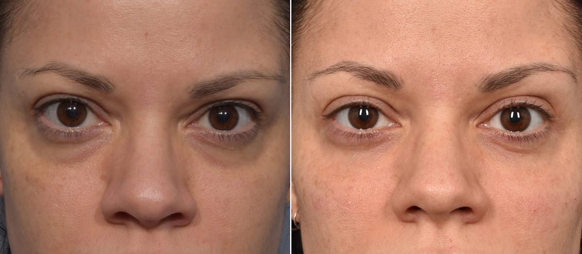 Lower Blepharoplasty Before & After Gallery - Patient 340200 - Image 6