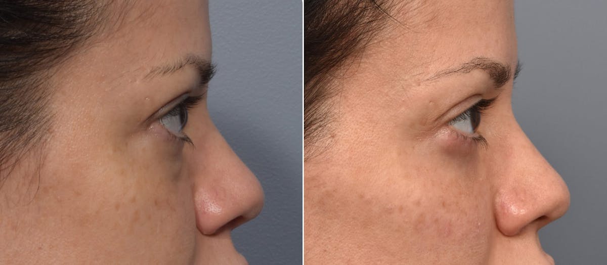Lower Blepharoplasty Before & After Gallery - Patient 340200 - Image 4