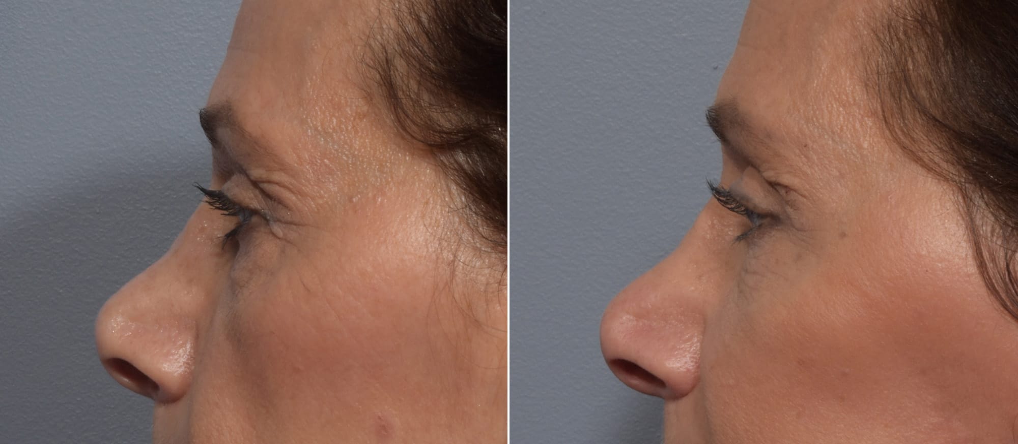 Lower Blepharoplasty Before & After Gallery - Patient 260133 - Image 5