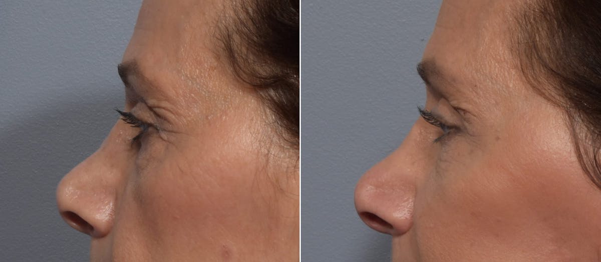 Lower Blepharoplasty Before & After Gallery - Patient 260133 - Image 5