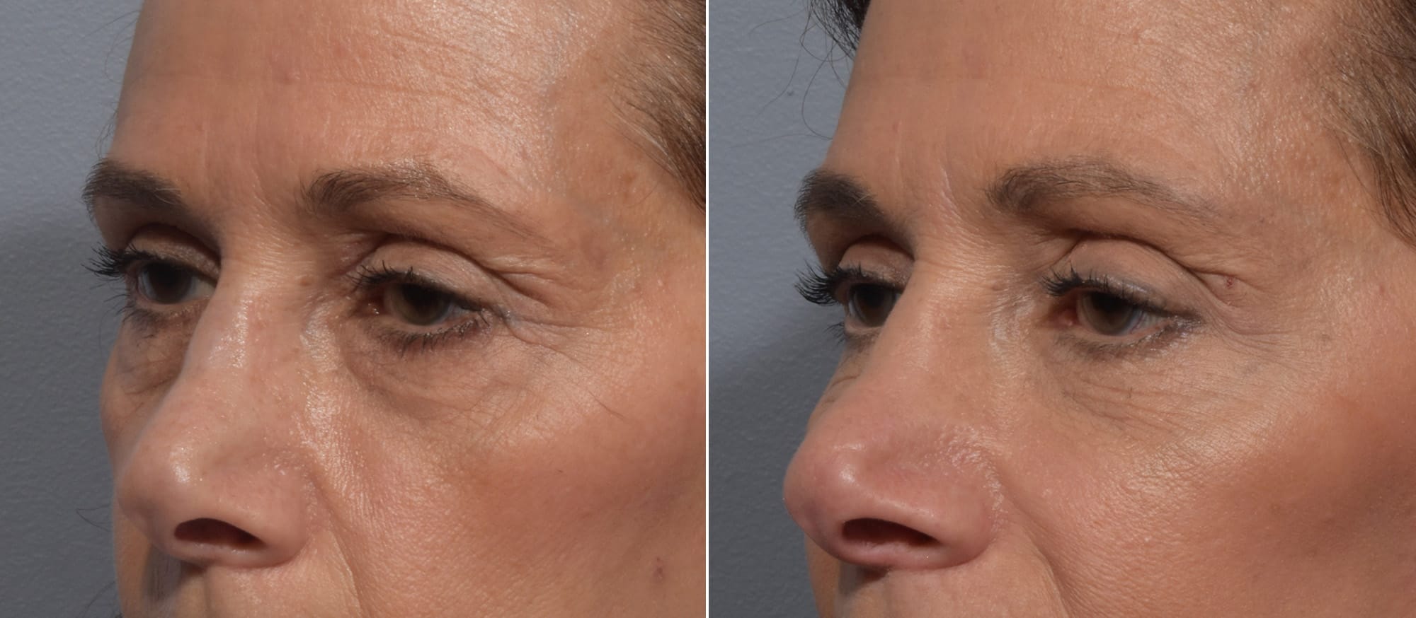 Lower Blepharoplasty Before & After Gallery - Patient 260133 - Image 1