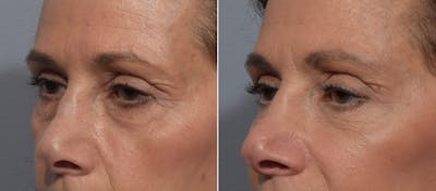 Lower Blepharoplasty Before & After Gallery - Patient 260133 - Image 1