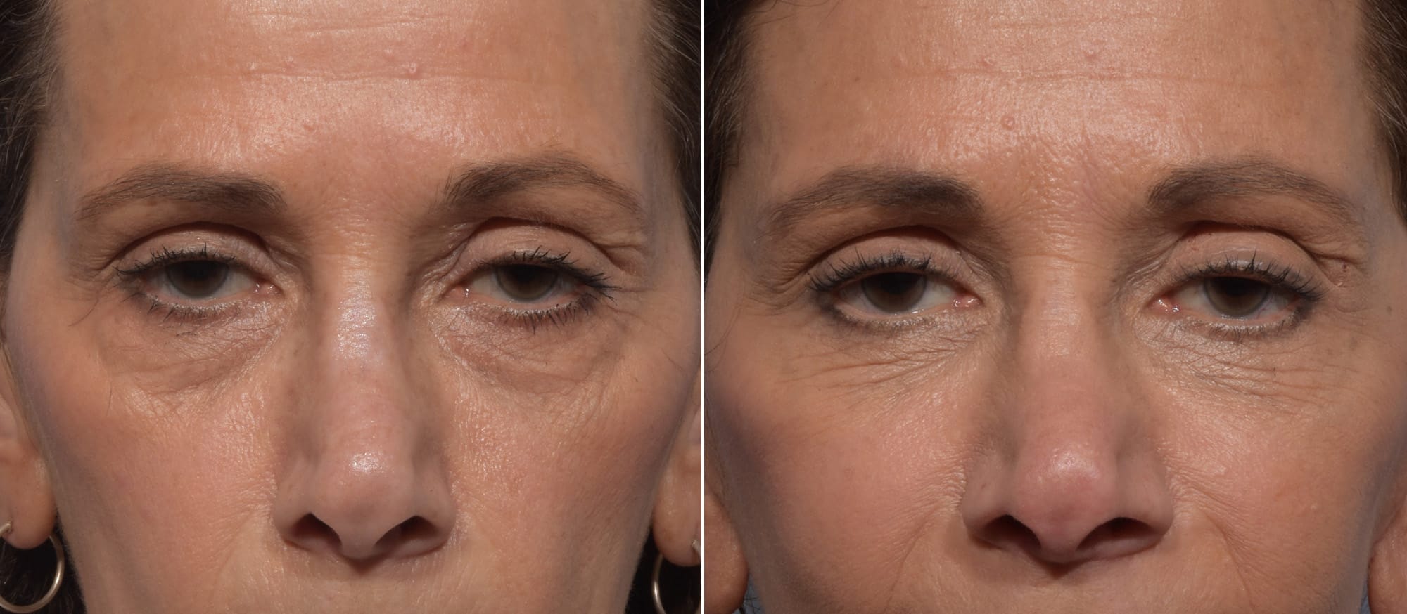 Lower Blepharoplasty Before & After Gallery - Patient 260133 - Image 2