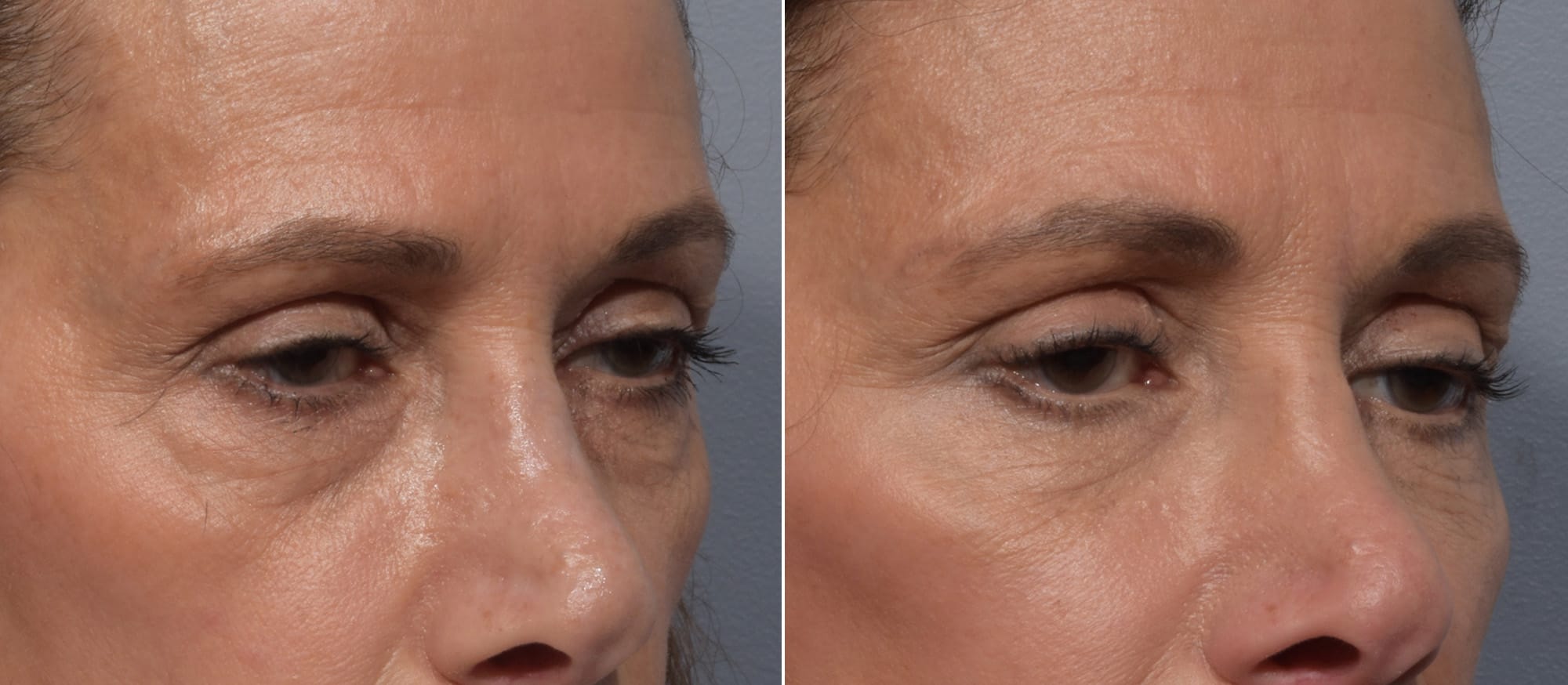 Lower Blepharoplasty Before & After Gallery - Patient 260133 - Image 4