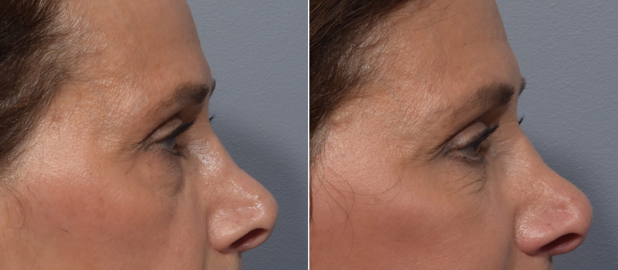 Lower Blepharoplasty Before & After Gallery - Patient 260133 - Image 3