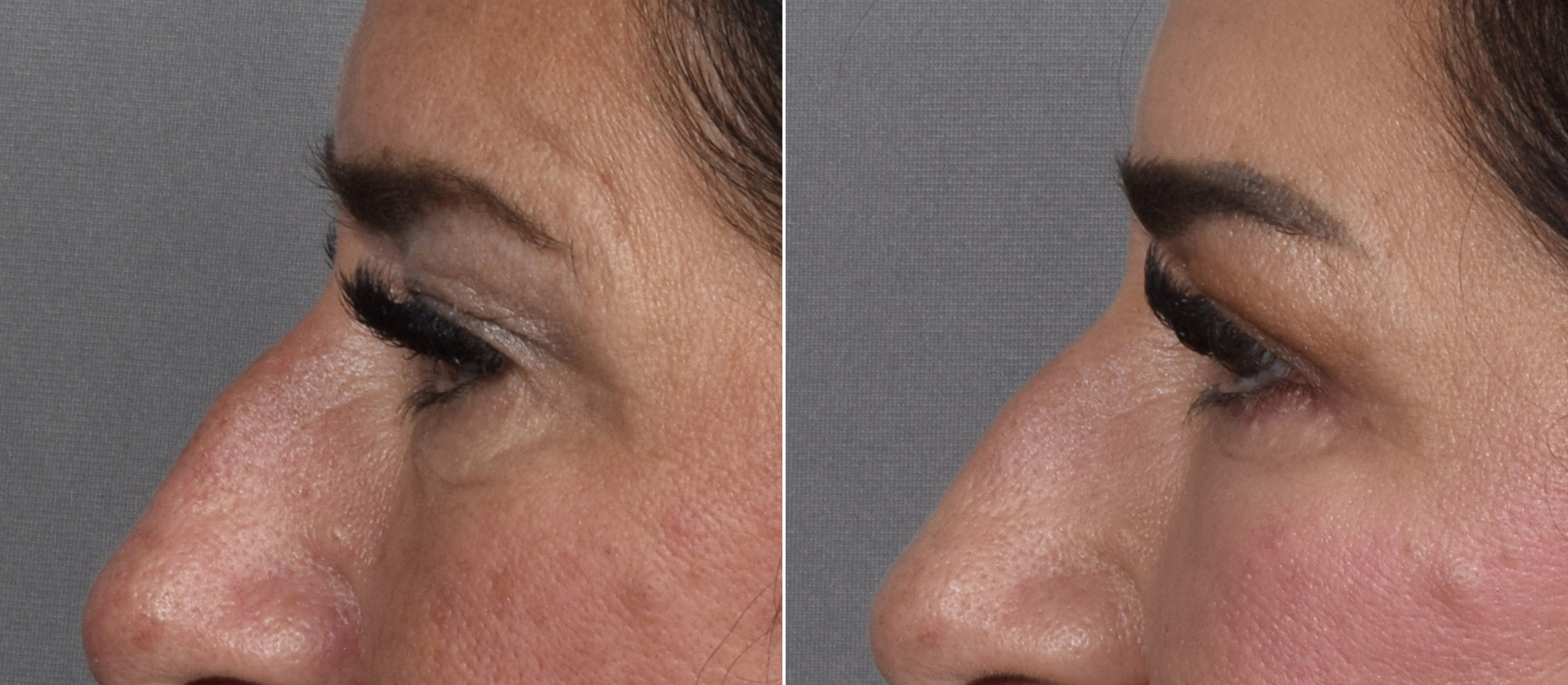 Upper Blepharoplasty Before & After Gallery - Patient 204321 - Image 4